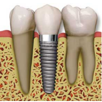 implant dentaire paris 6 eme