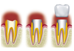 Inlay Onlay Dentiste Paris 7